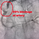 Illustration for article titled Cardiac Catheterization - it’s been a fun two days